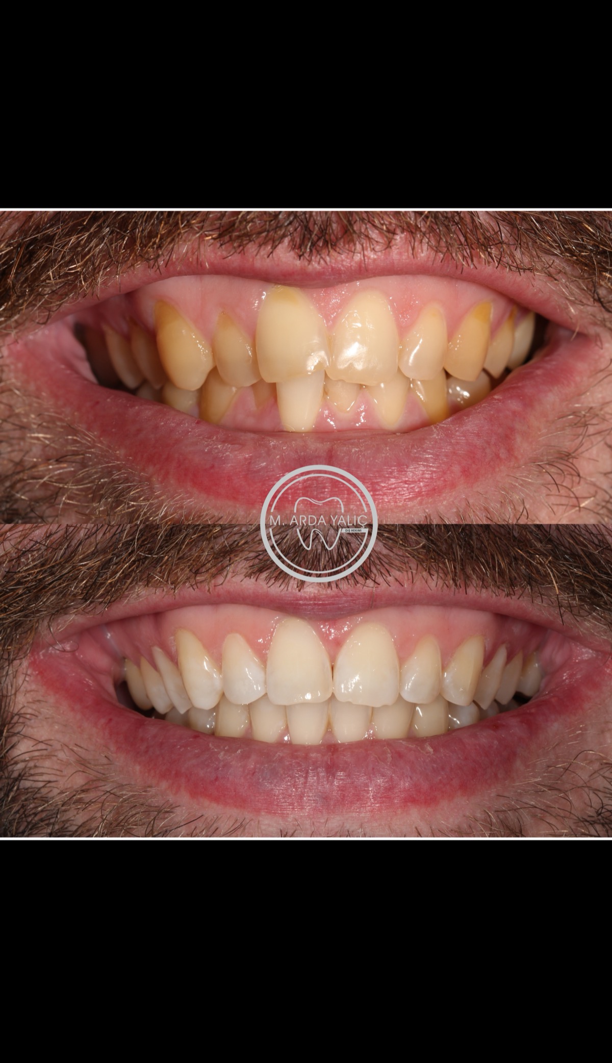 Dental treatment before and after result 01