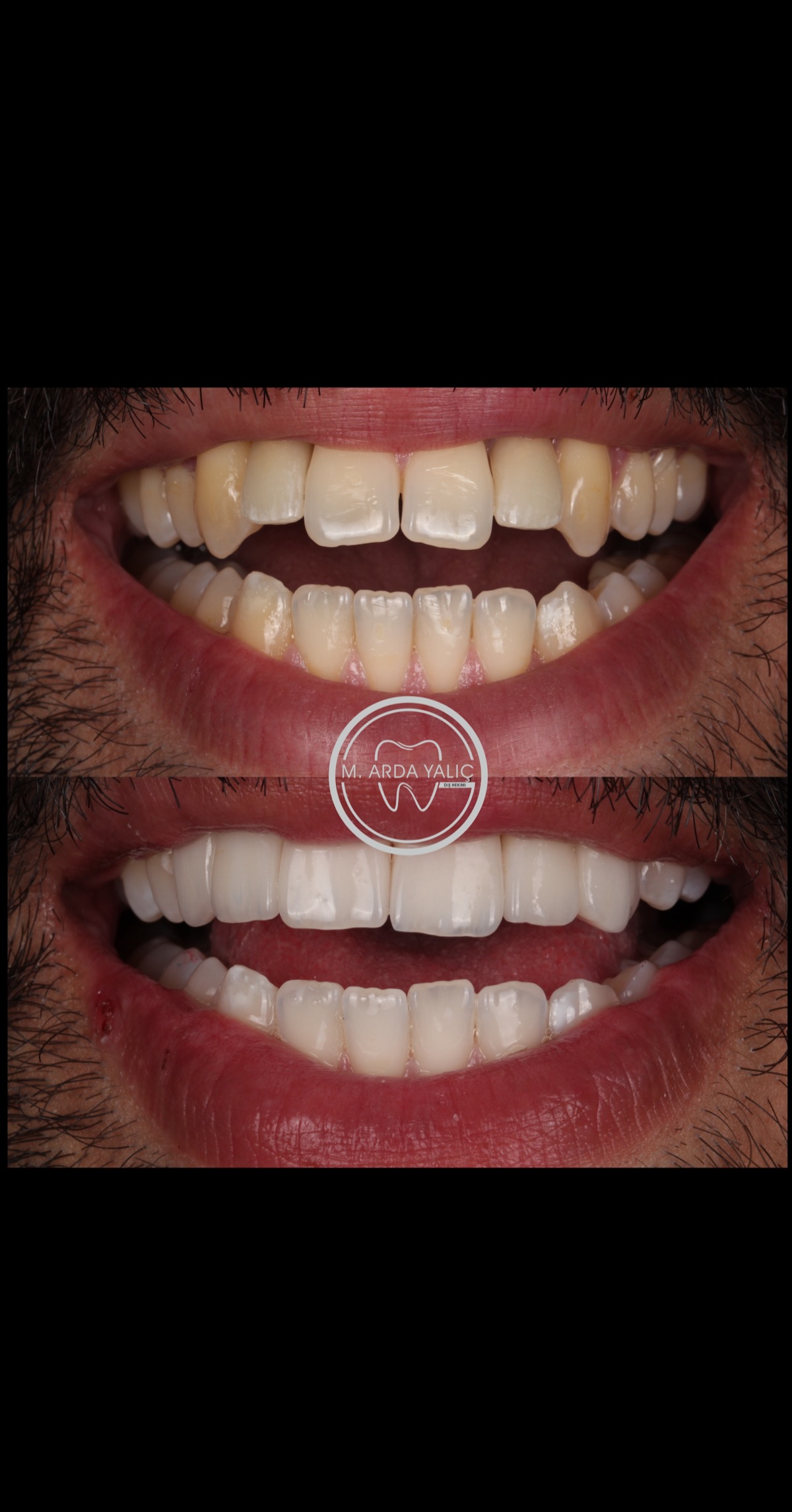 Dental treatment before and after result 02