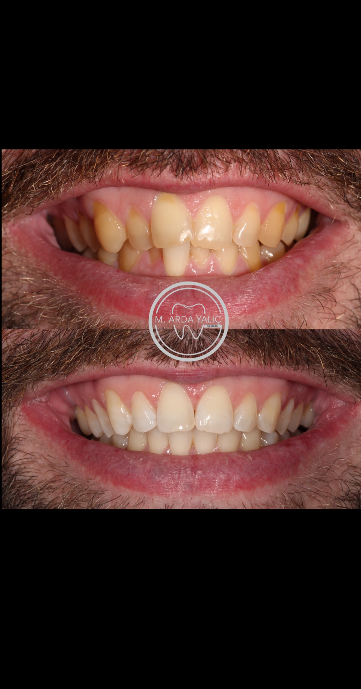 Dental treatment before and after result 03