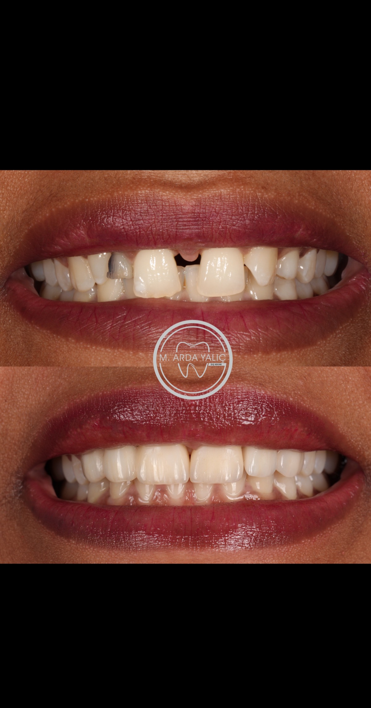 Dental treatment before and after result 05