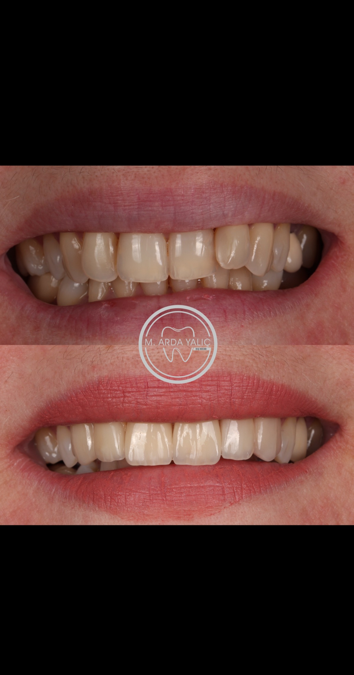 Dental treatment before and after result 06
