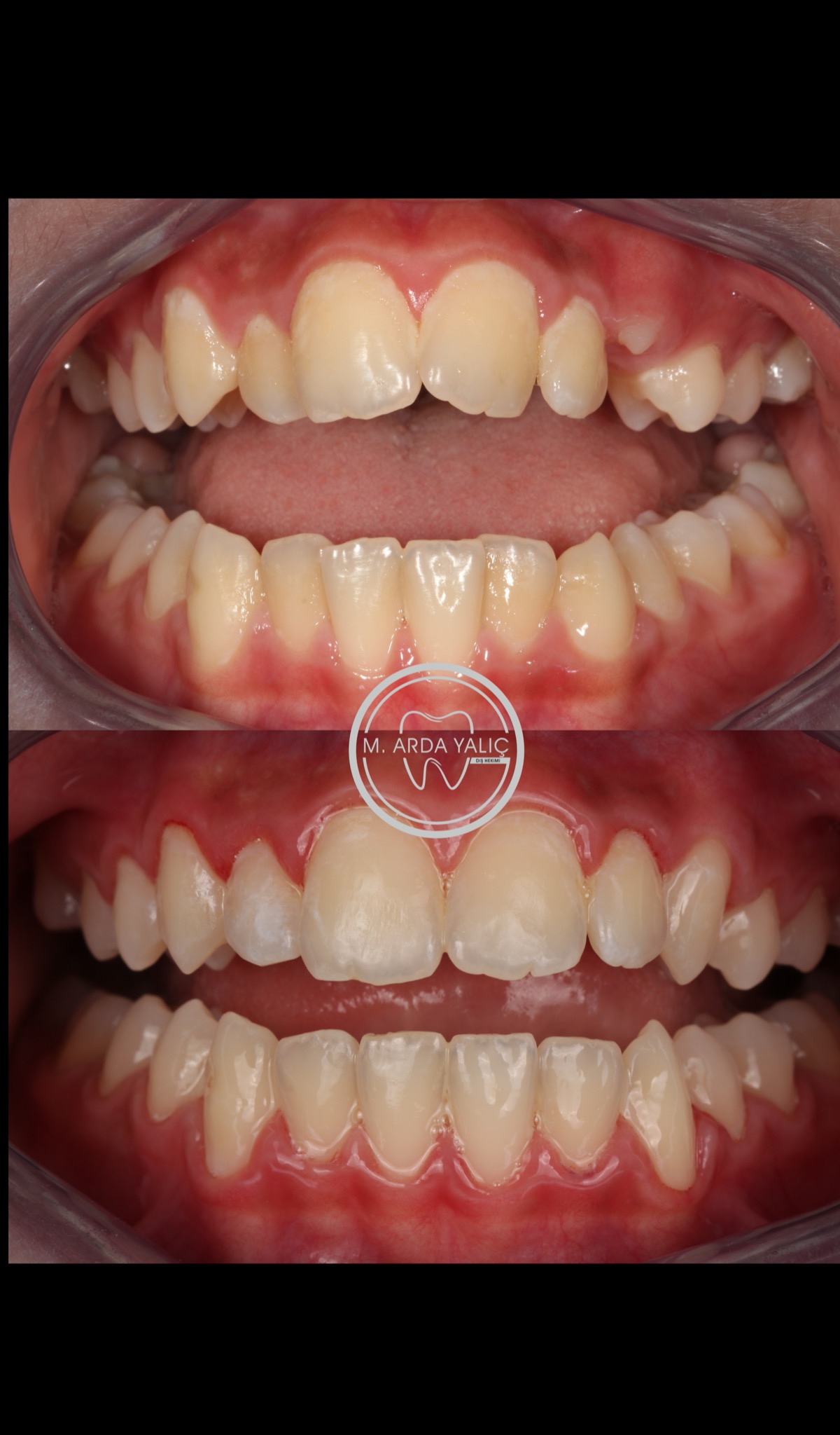 Dental treatment before and after result 10