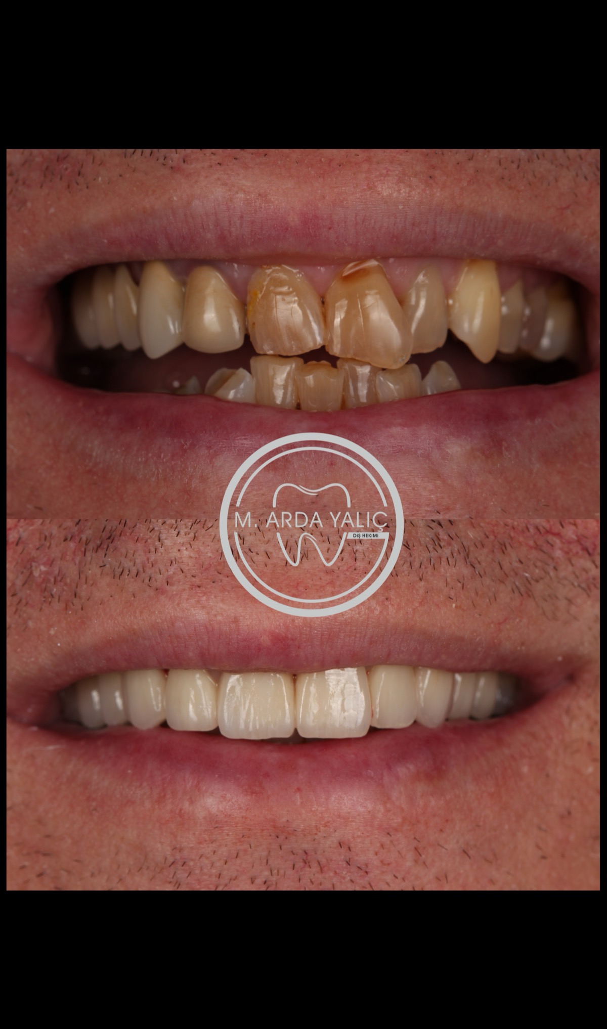Dental treatment before and after result 14