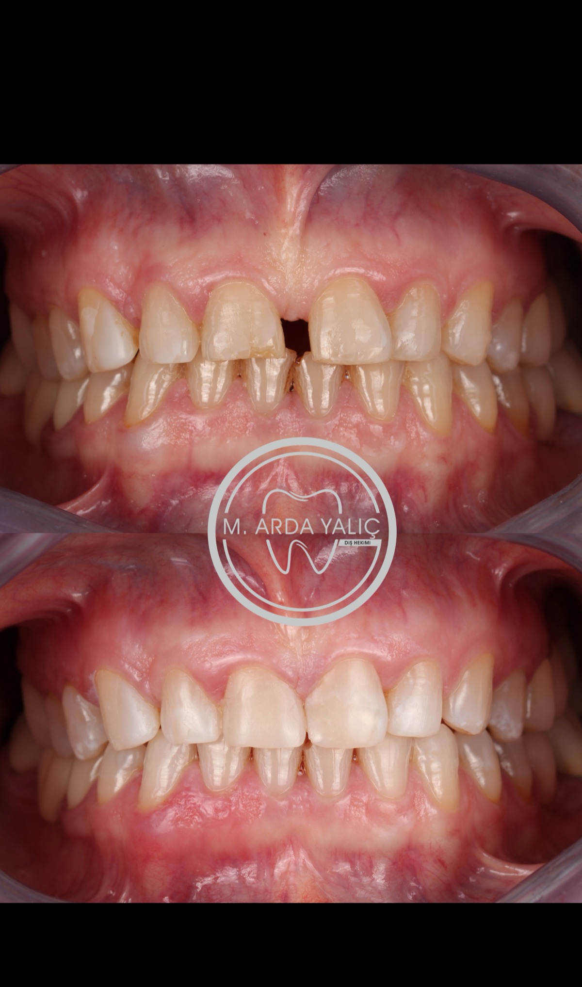 Dental treatment before and after result 16