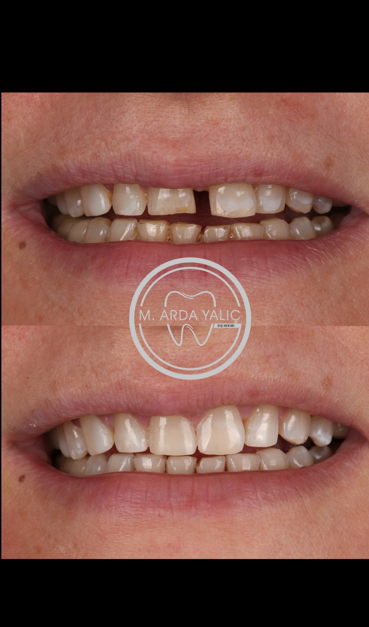 Dental treatment before and after result 17