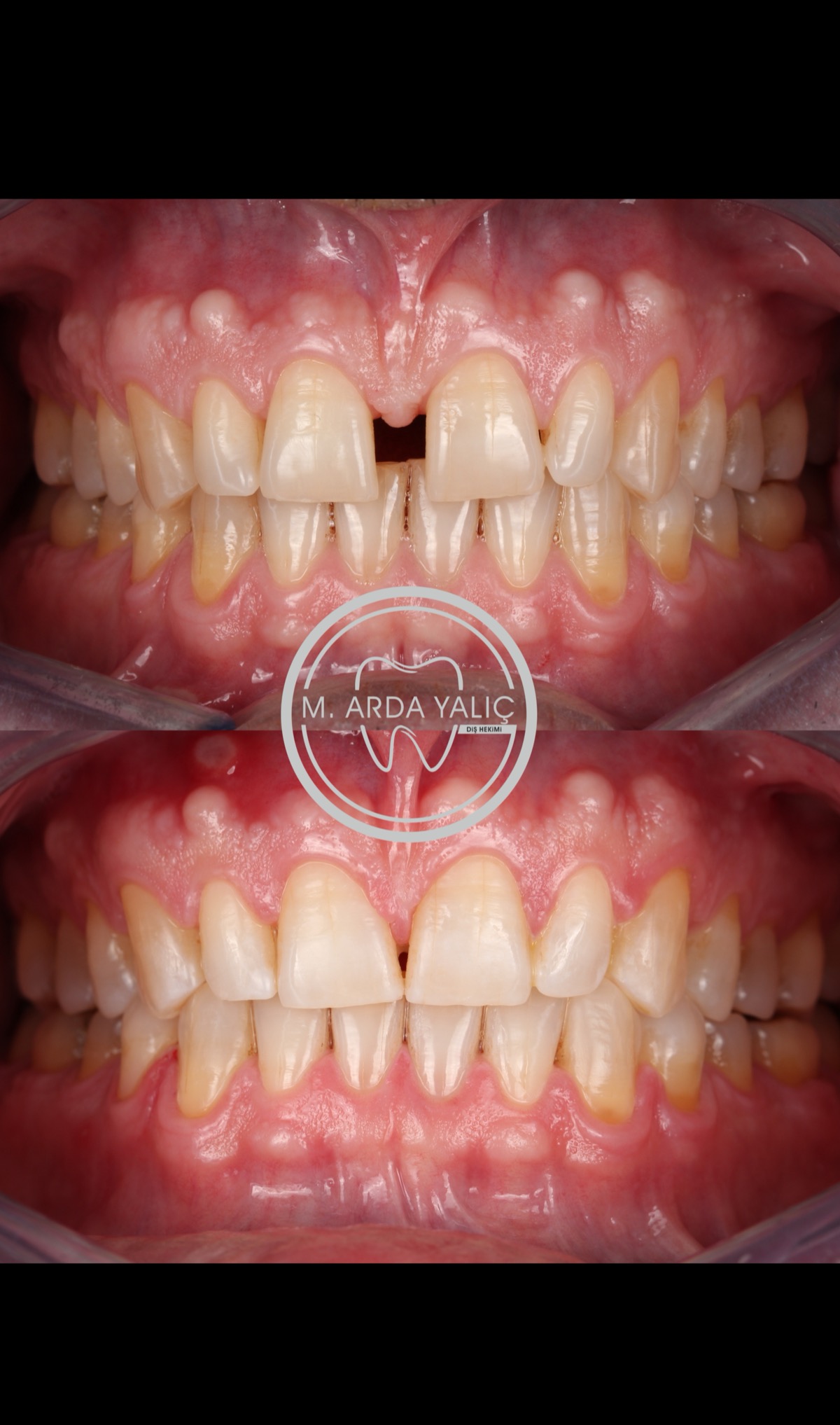 Dental treatment before and after result 19