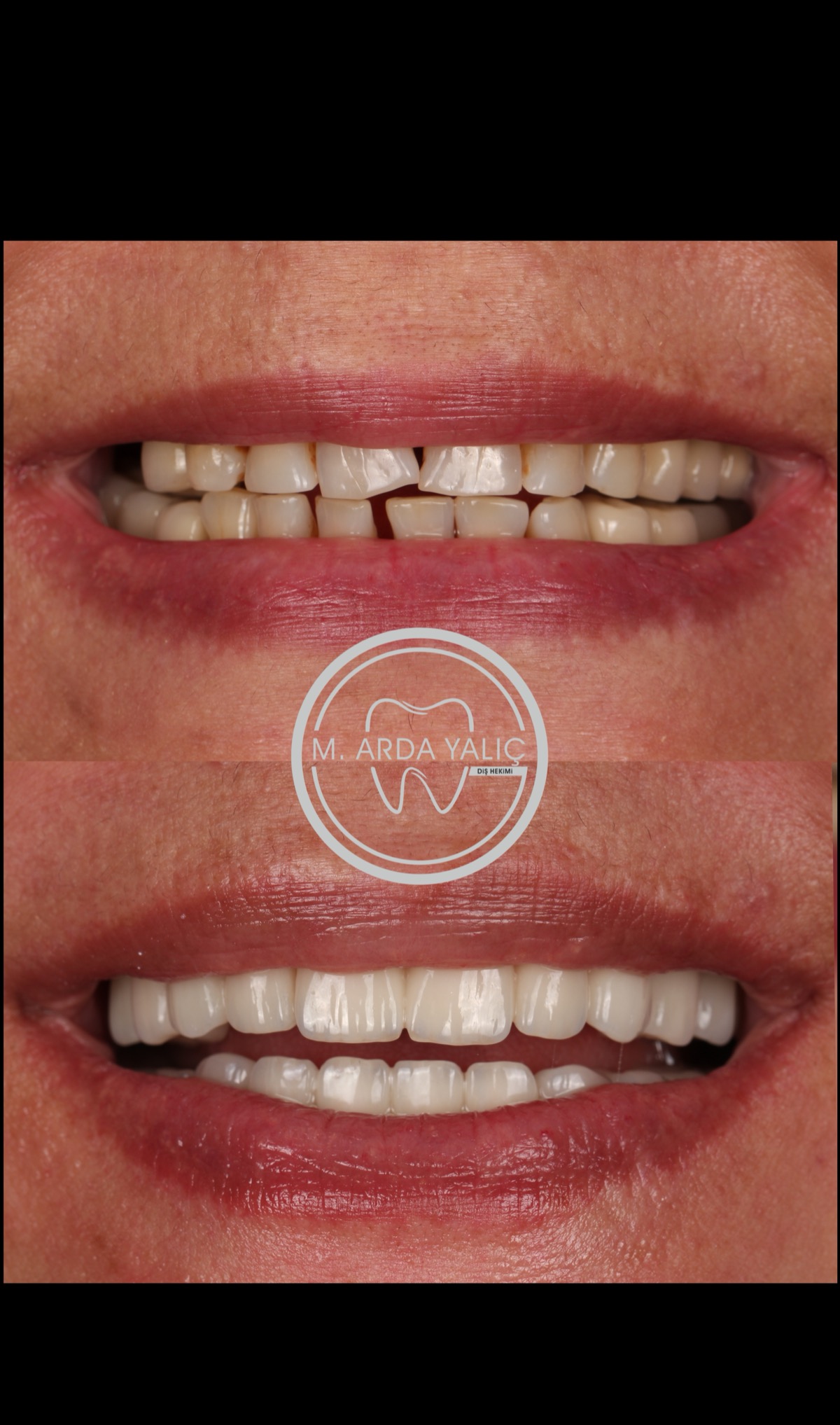 Dental treatment before and after result 24
