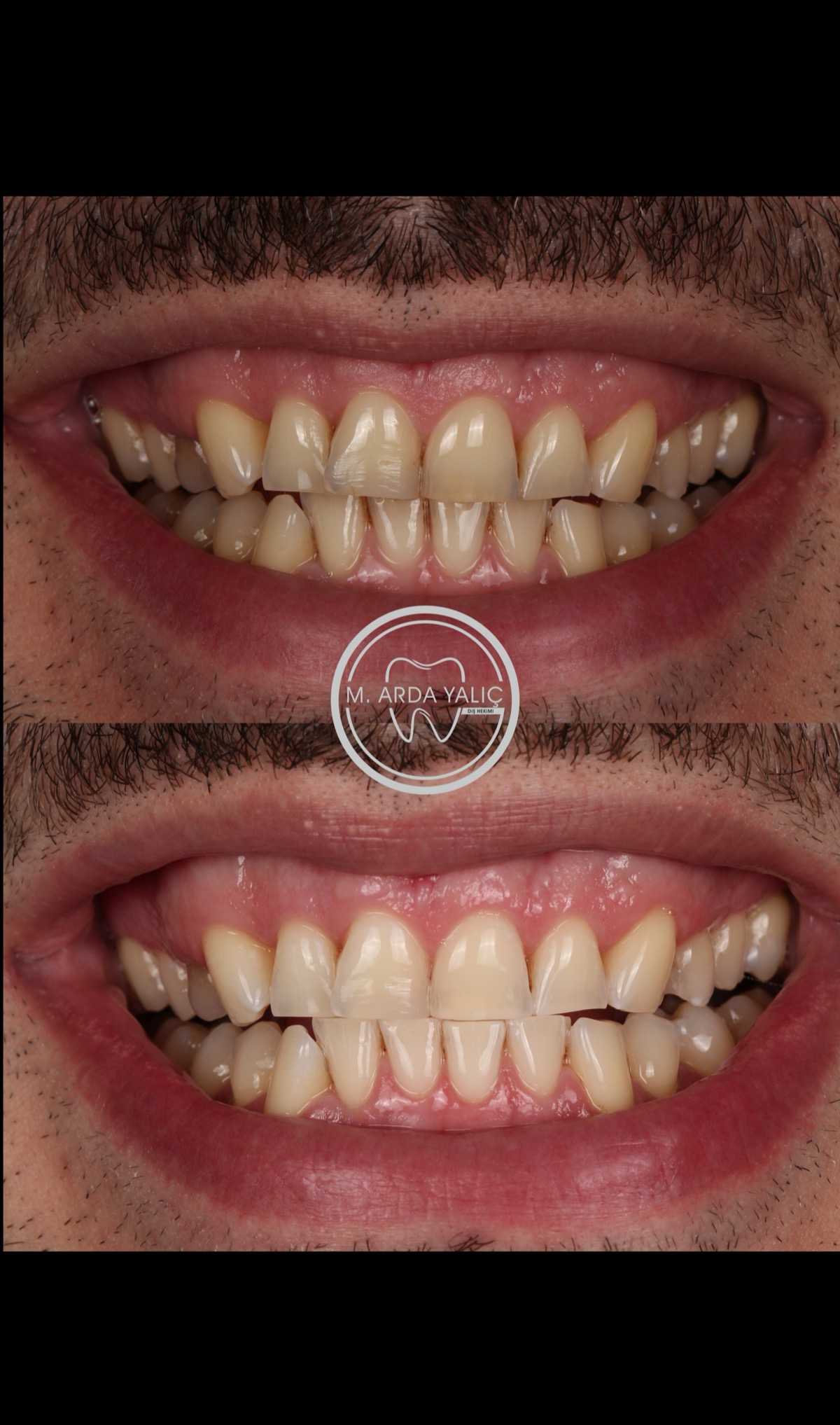 Dental treatment before and after result 33
