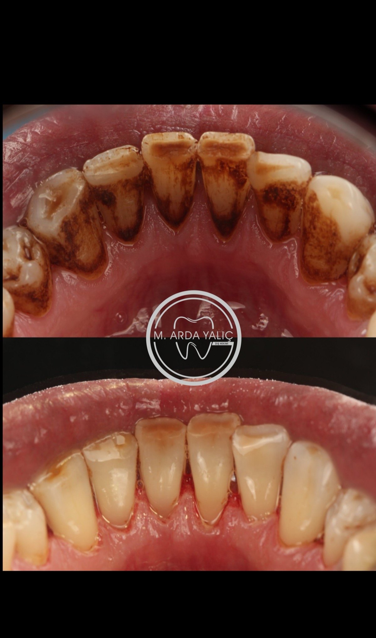 Dental treatment before and after result 35